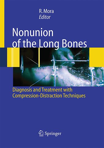 Nonunion of the Long Bones