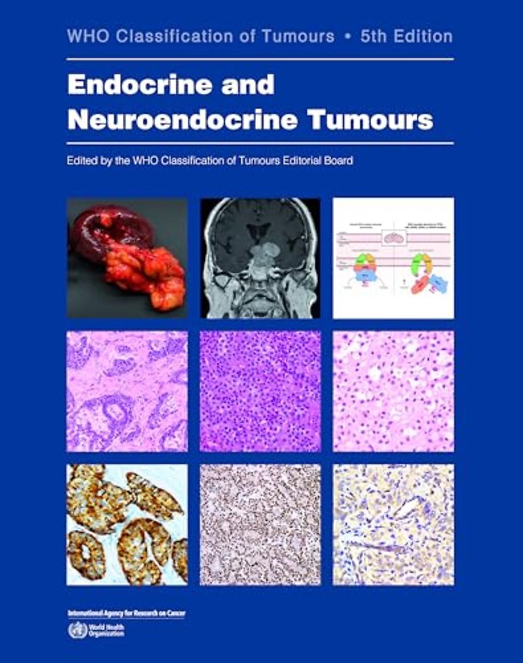 Endocrine and Neuroendocrine Tumours