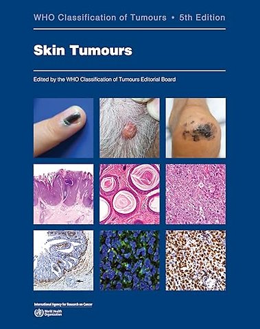 Skin Tumours Who Classification of Tumours