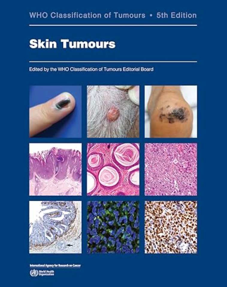Skin Tumours Who Classification of Tumours
