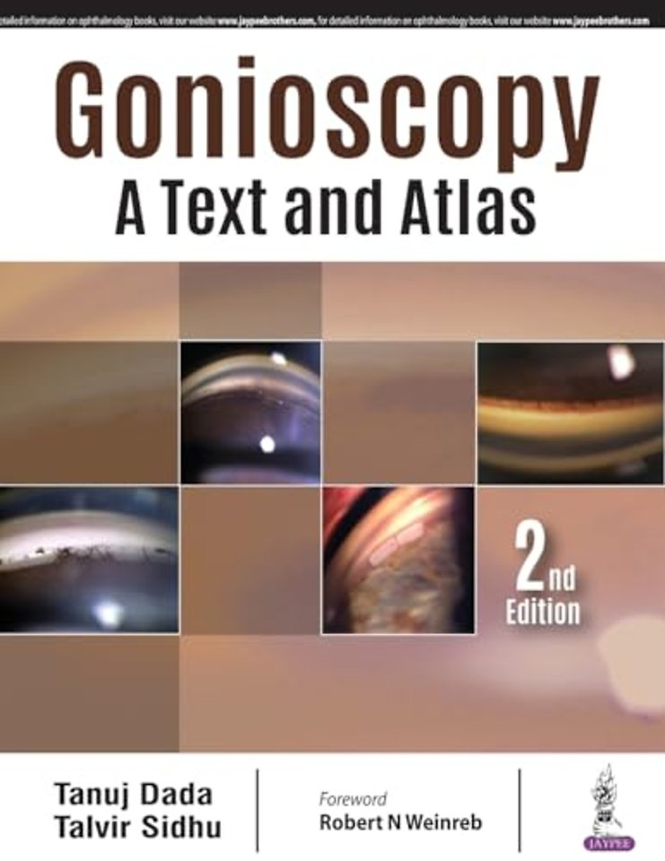 Gonioscopy: A Text and Atlas