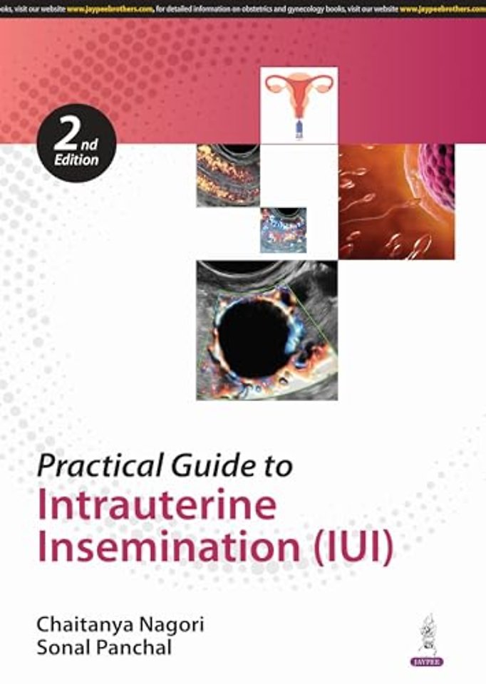 Practical Guide to Intrauterine Insemination (IUI)