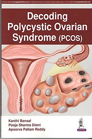 Decoding Polycystic Ovarian Syndrome