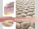 Psoriasis
