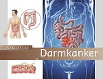 Zorgatlas Darmkanker